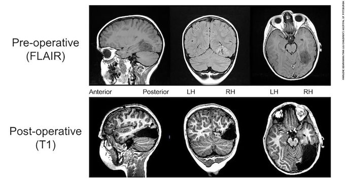 When surgeons removed one sixth of a child's brain, here's what happened