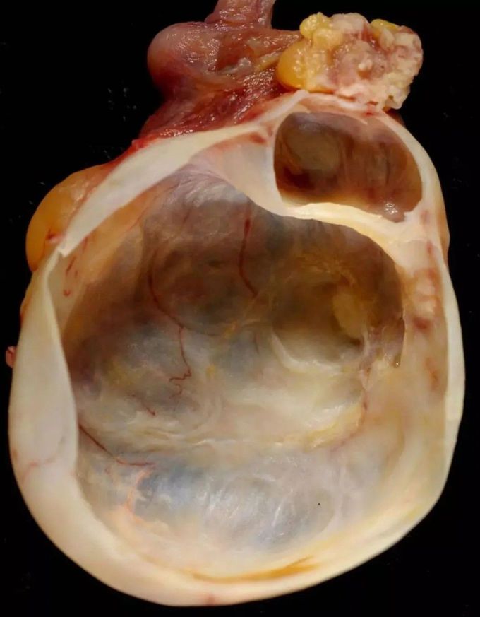 Mucinous Cystadenoma