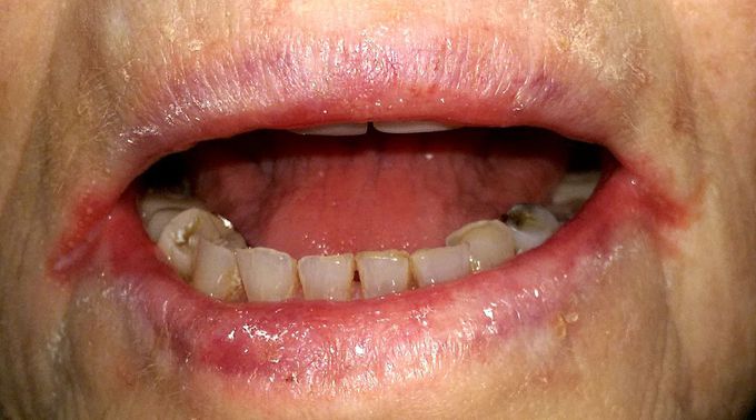 Symptoms of angular cheilitis