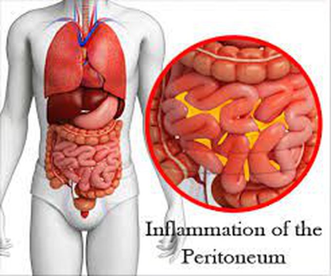 What is peritonitis?