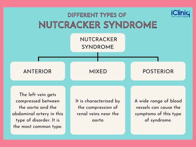 Types of Nutcracker Syndrome