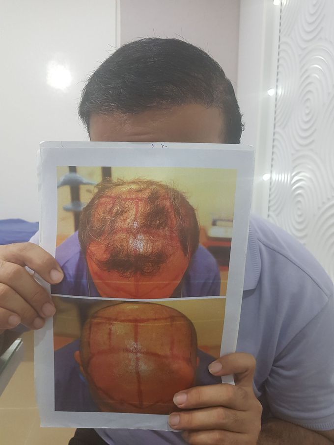 Hairtransplant
