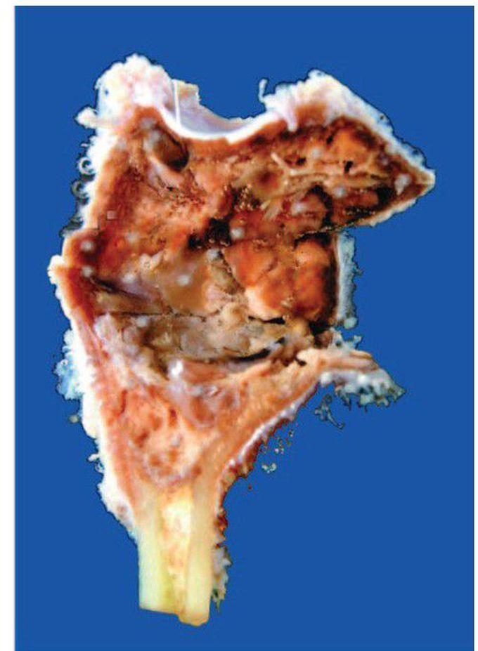 Aneurysmal bone cyst, ulna.