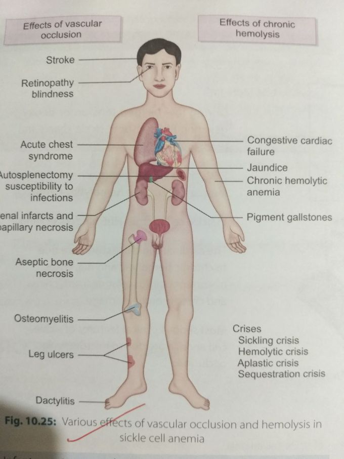 Clinical features of sickle cell anemia