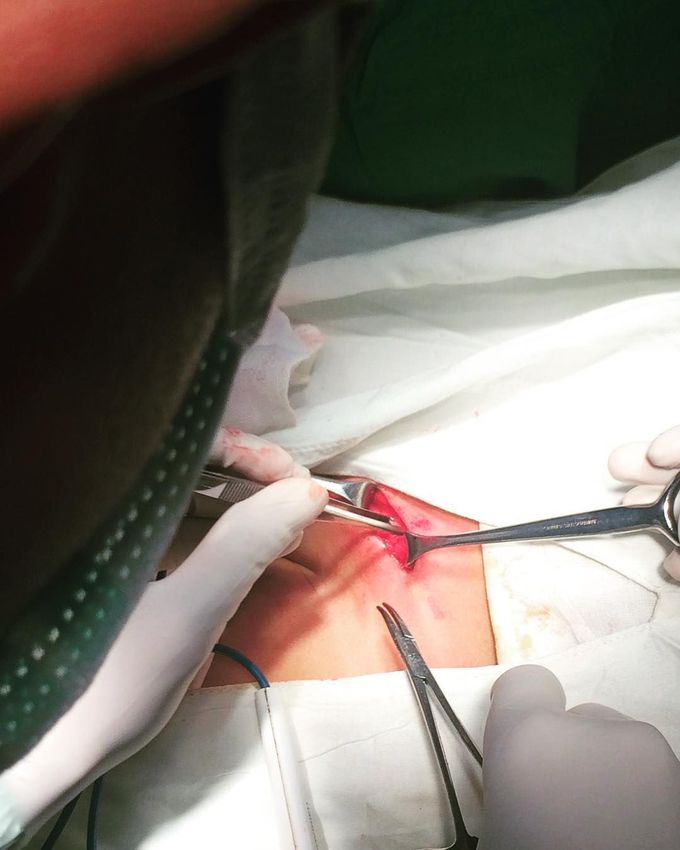 Incision
