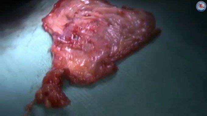 Thoracoscopic diaphragm plication