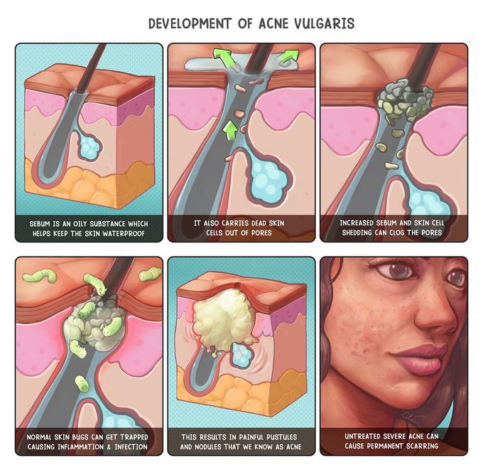 Development of Acne Vulgaris