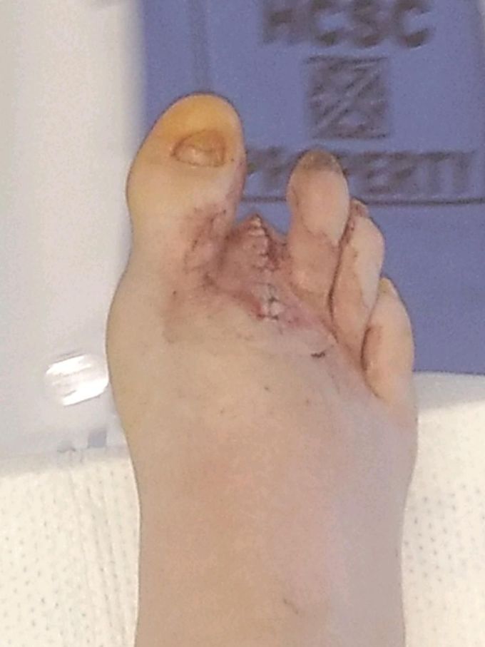 Fresh Toe Amputation