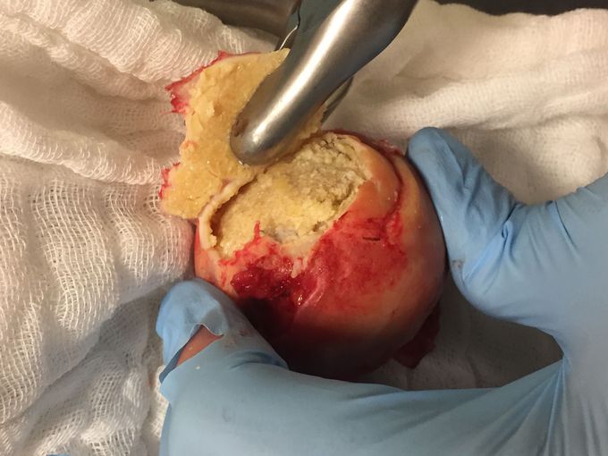 Hip avascular necrosis