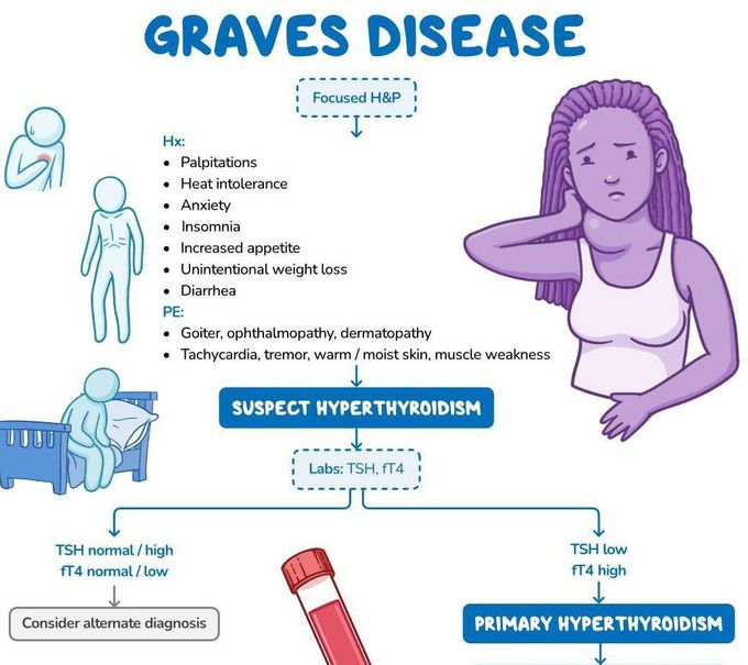 Graves Disease