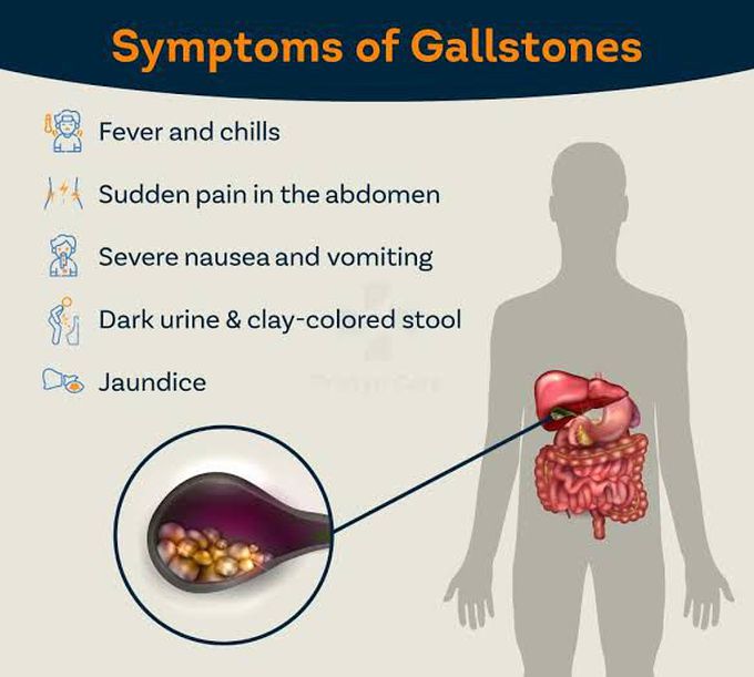 Symptoms of gallstones