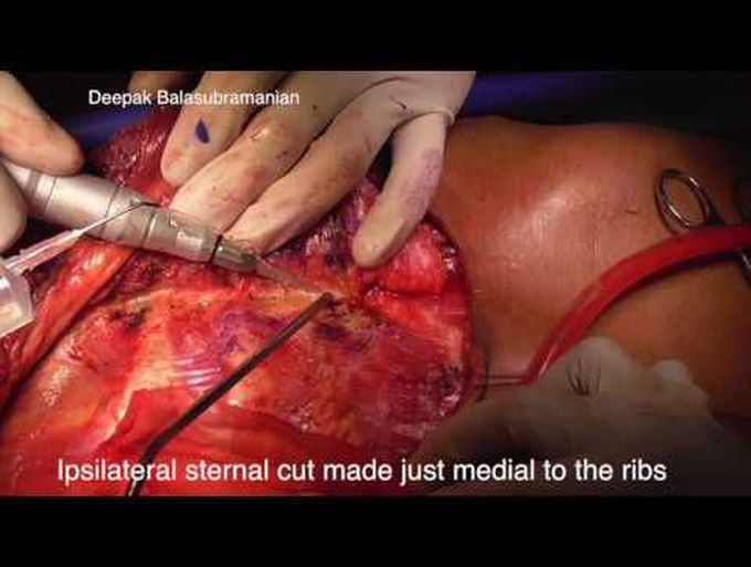 Pedicled pectoralis major sternum flap for mandible reconstruction
