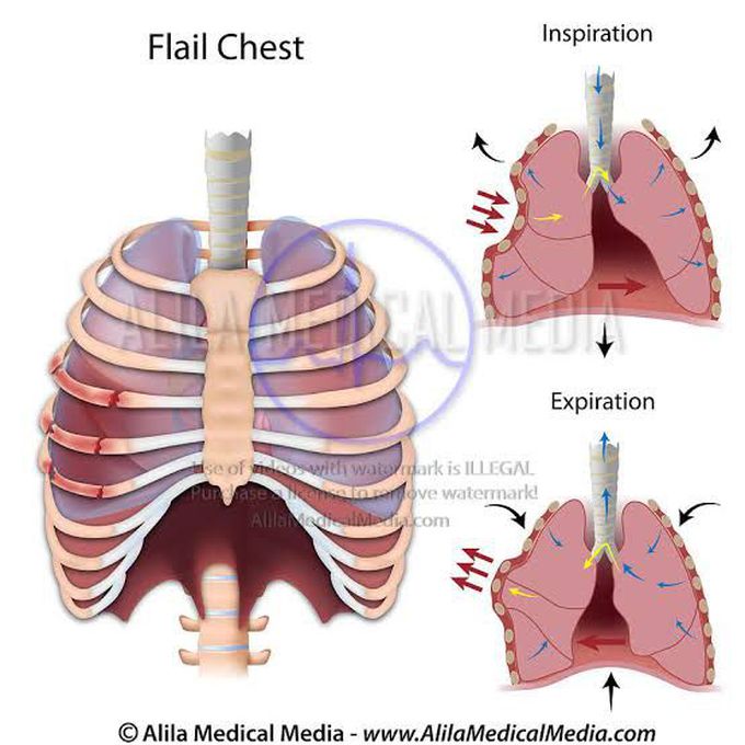 Causes of flail chest