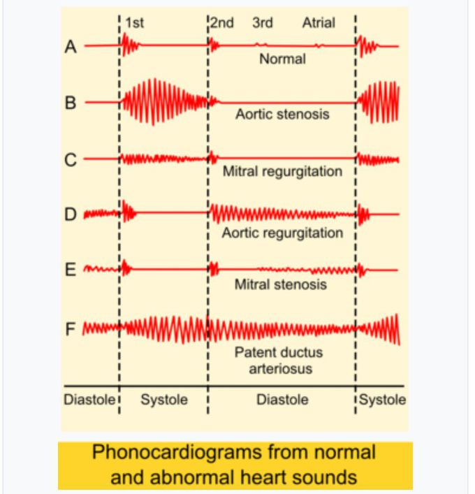 Cardiac murmers and other sounds