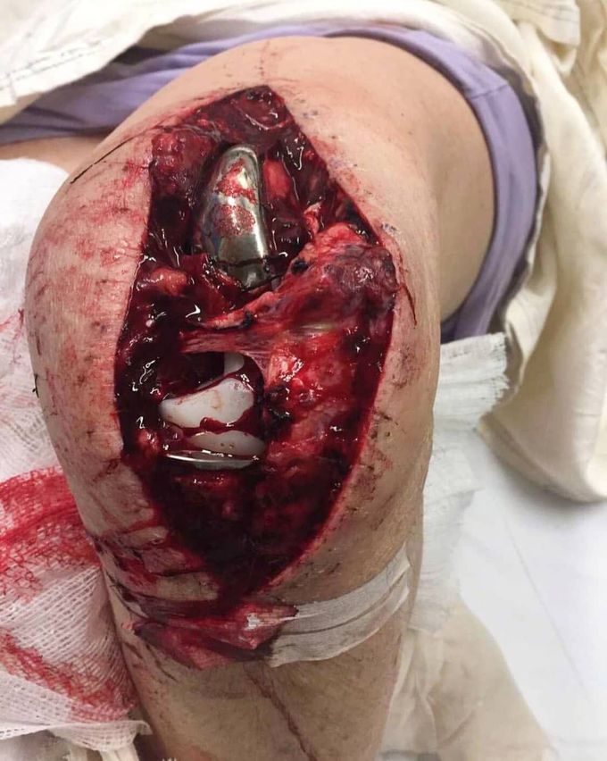 Knee injury 