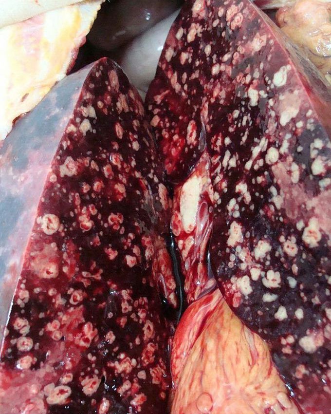 An amazing shot of Splenic Tuberculosis