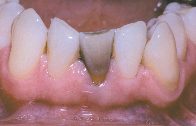 Amalgam discolouration