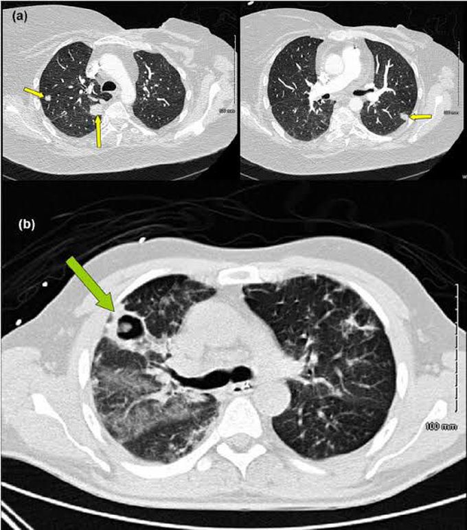 BRONCHOPULMONARY Aspergillosis