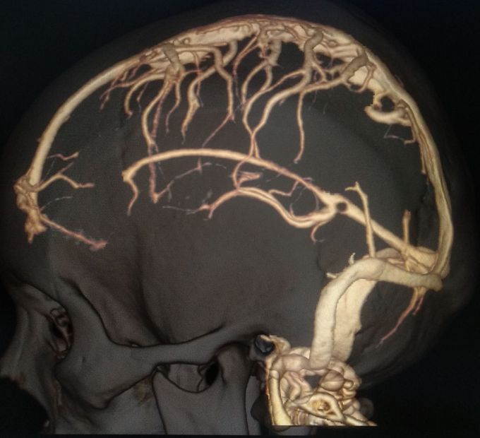 Brain venography