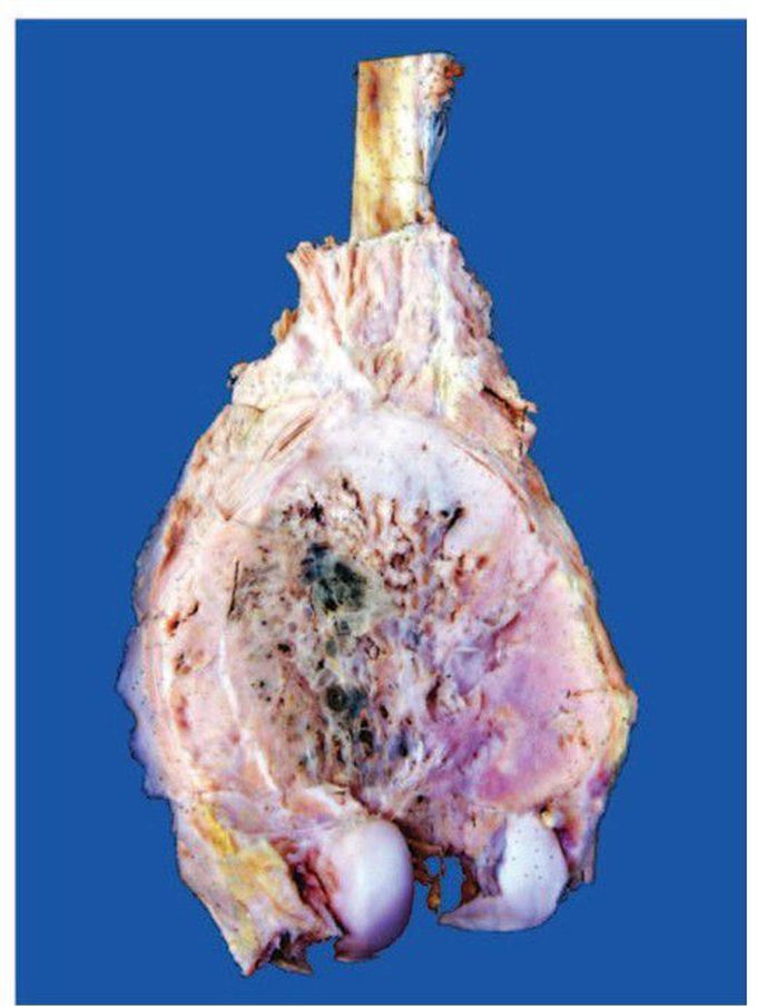 Osteosarcoma