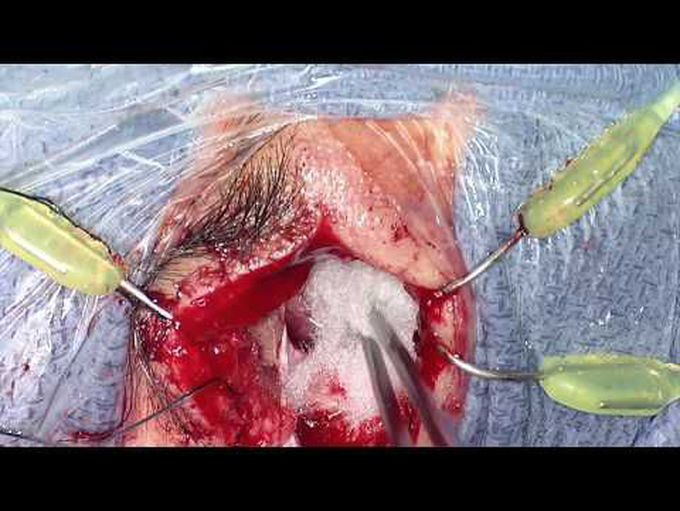 Lt ant cranial fossa dural arteriovenous fistula ligation using a supra-orbital (eyebrow) craniotomy
