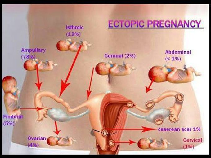 Ectopic Pregnancy