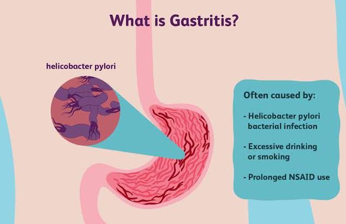 Gastritis