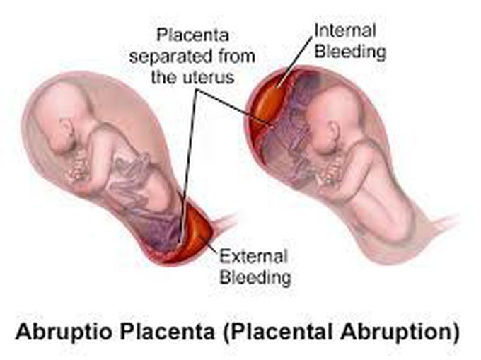 Antepartum haemorrhage