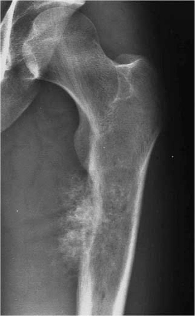 Chondrosarcoma