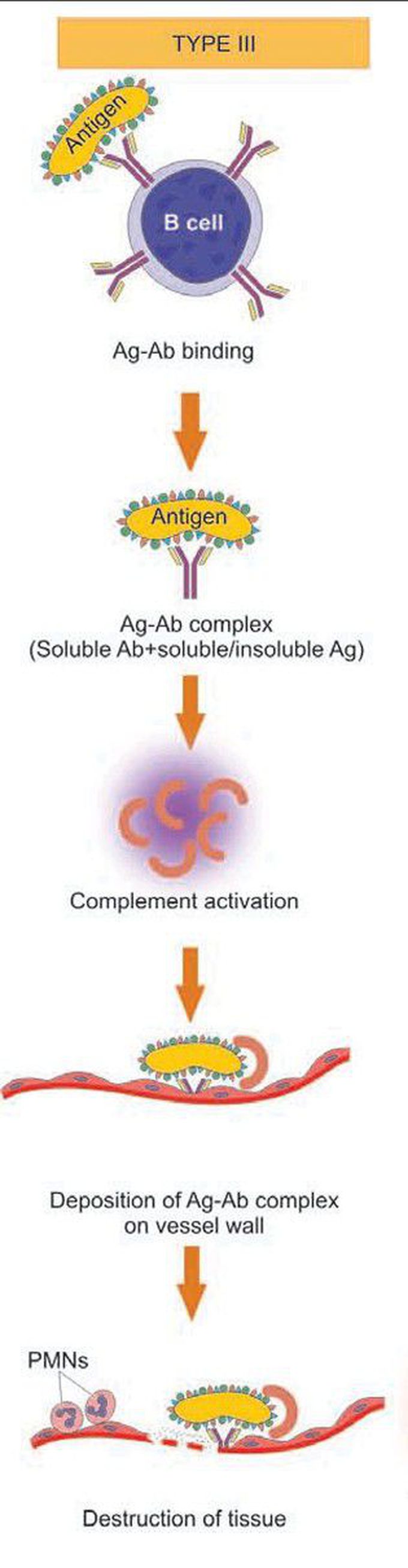 Type 3 hypersensitivity