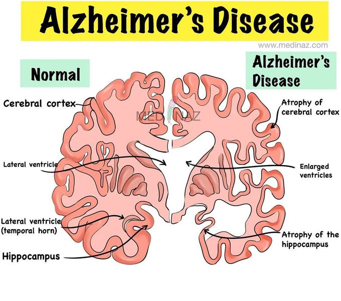 Normal Vs Alzheimer's Brain