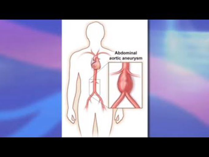 Endovascular Abdominal Aortic 
Aneurysm Repair