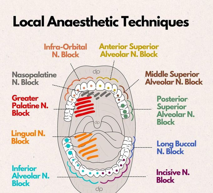 Local Anesthesia Techniques