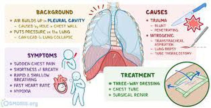 Causes of pneumothorax