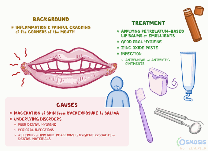 Causes of angular cheilitis