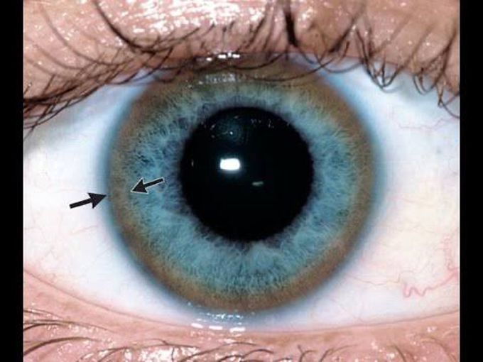 Wilson disease