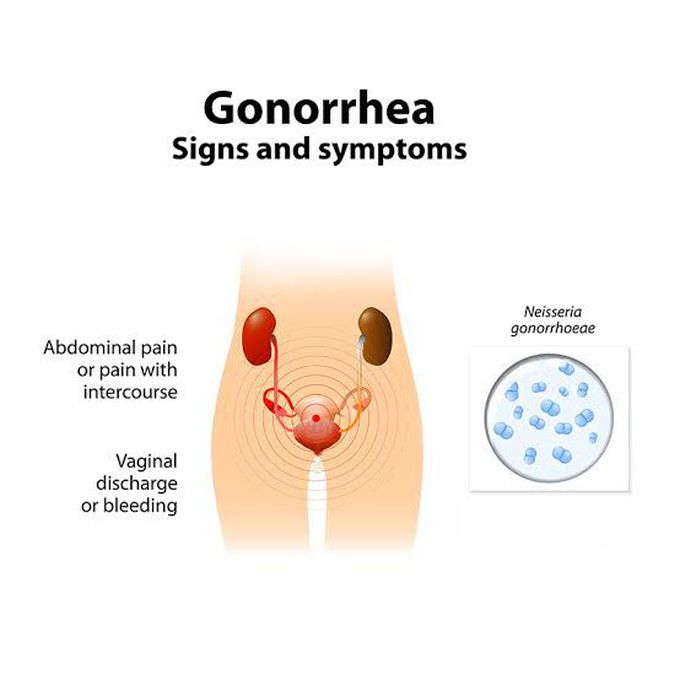 Sign and symptoms of gonorrha