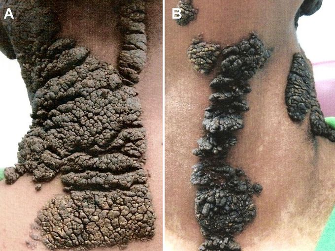 EPIDERMAL NEVUS SYNDROME