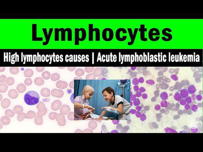 Etiology Of Lymphocytosis and Acute lymphoblastic leukaemia explained
