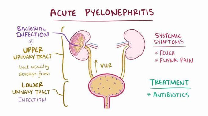 Pyelonephritis