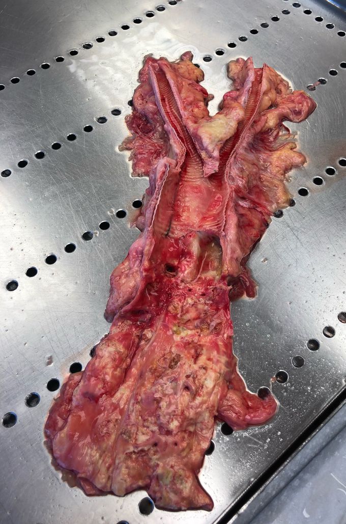 Severe atherosclerosis