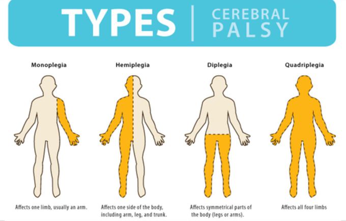 Cerebral palsy