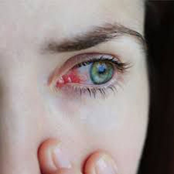 Keratoconjunctivitis