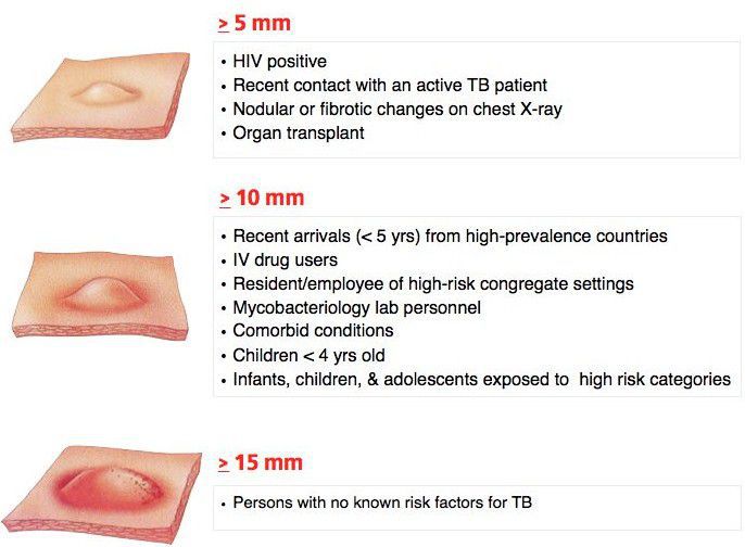 Classification Of The PPD Tuberculin Skin Test Reaction MEDizzy