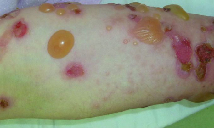 Bullous pemphigoid on the arm
