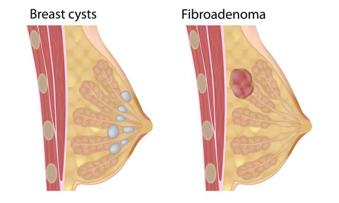 Common Benign Breast Lumps