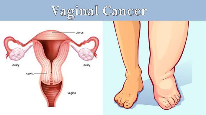 Vaginal cancer