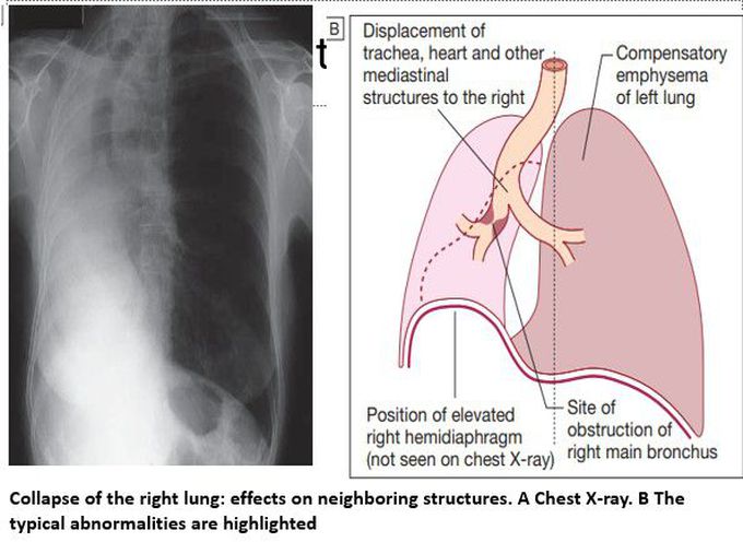 Collapse of the Lung