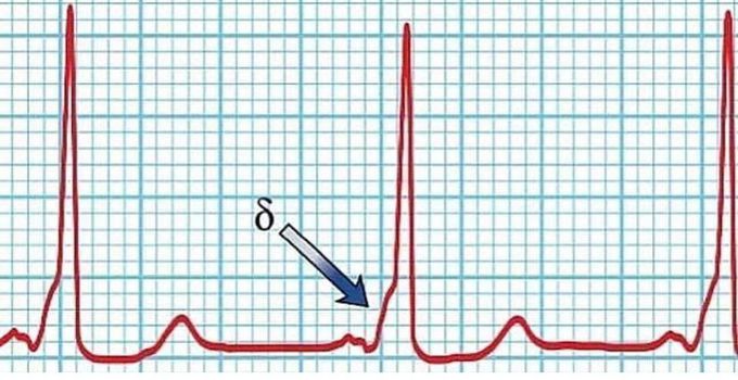 Wolff-Parkinson-White (WPW) syndrome