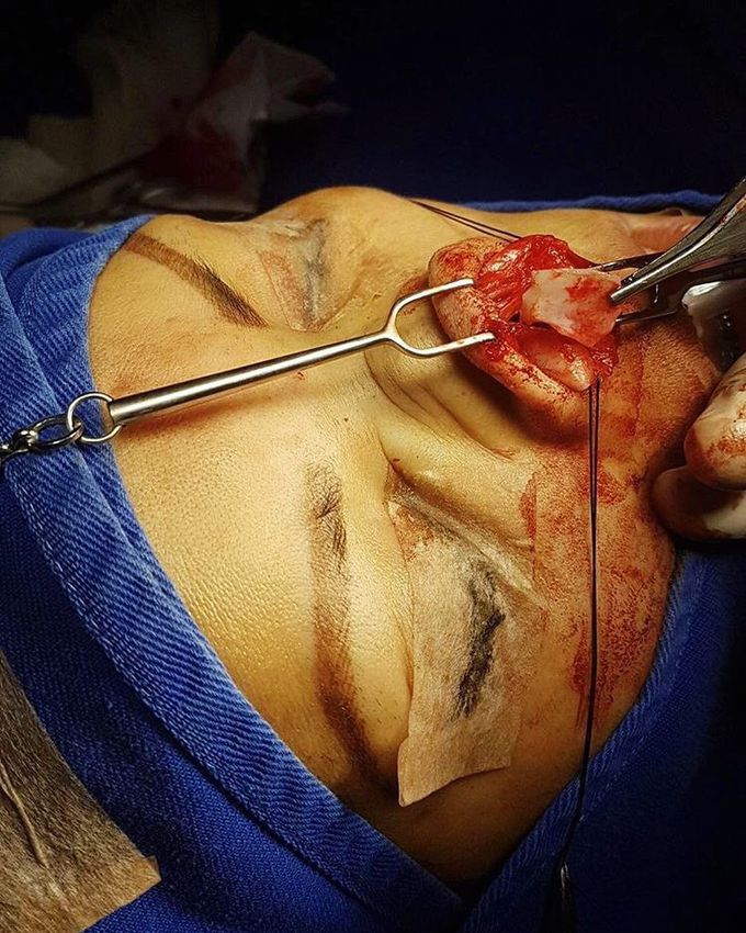 Here's a case of a Rhino-septoplasty